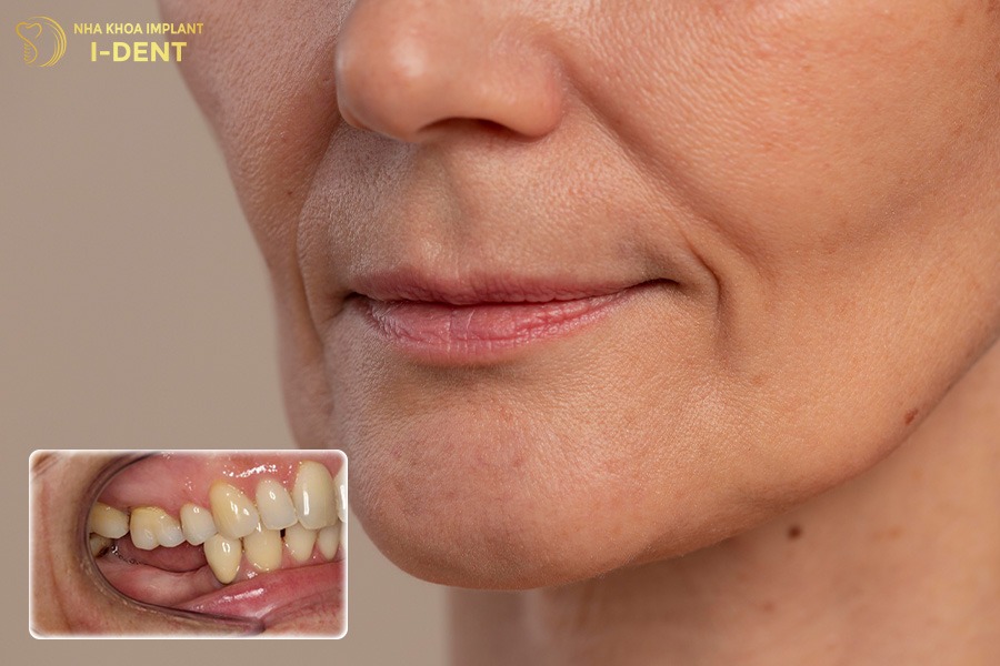 Mất răng hàm hoàn toàn có thể gây ra tình trạng hóp má mất răng hàm gây hóp má