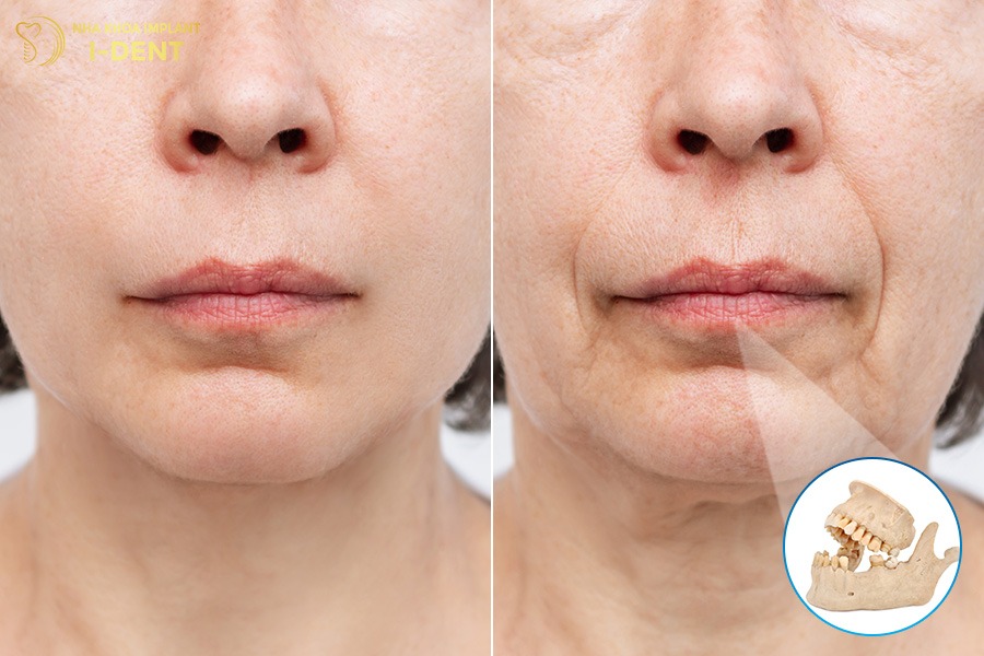 Mất răng không trồng lại gây tiêu xương hàm, lão hóa sớm không trồng răng có sao không