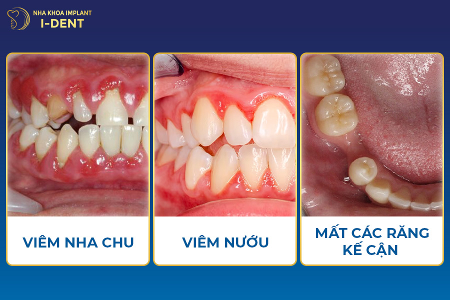 Mất răng không trồng lại làm tăng nguy cơ mắc các bệnh lý răng miệng mất răng không trồng lại có sao không