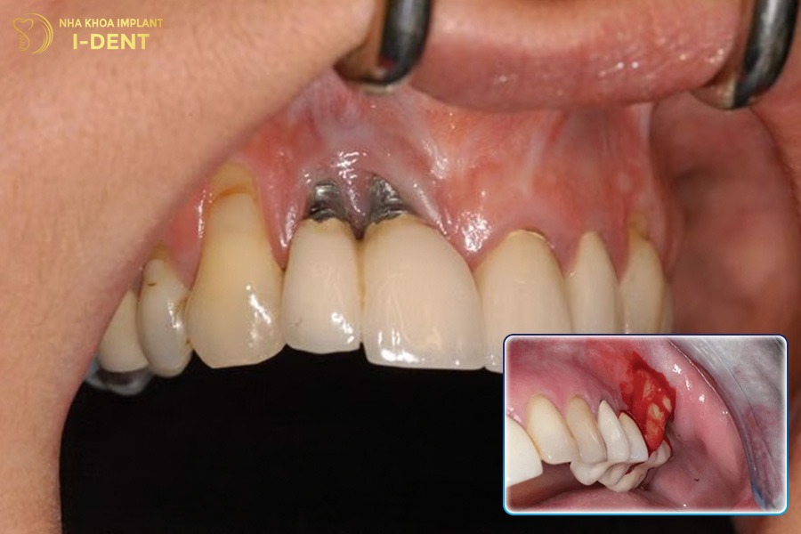 Nhiễm trùng vùng trồng răng Implant Nhiễm trùng vùng trồng răng Implant
