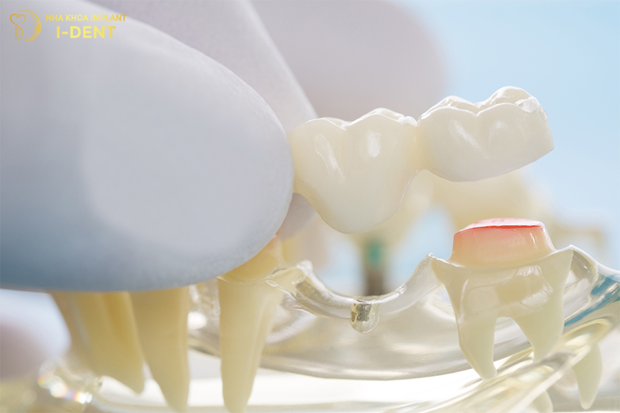 Phương pháp làm cầu răng sứ không trồng răng hàm có sao không