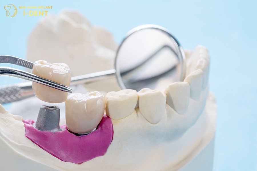 Phương pháp trồng răng implant không trồng răng có sao không