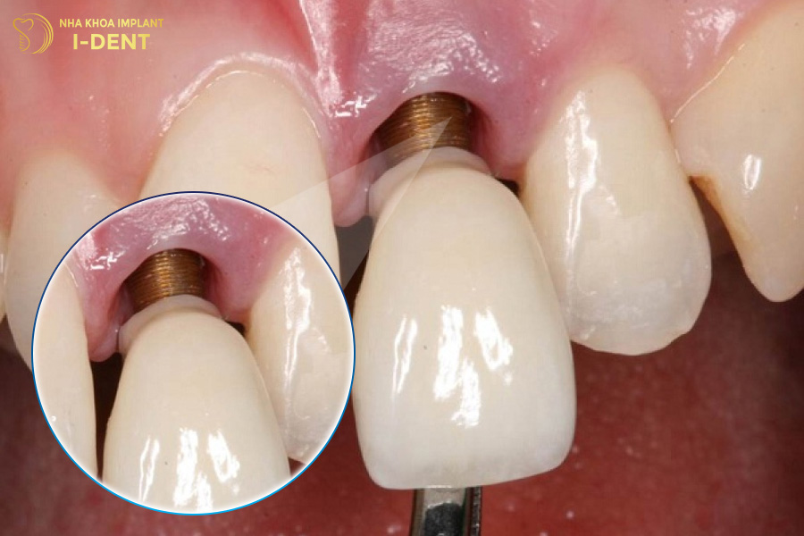 Răng Implant bị lung lay Răng Implant bị lung lay