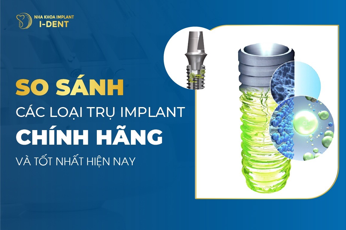 Trồng răng implant loại nào tốt? So sánh các loại trụ implant phổ biến
