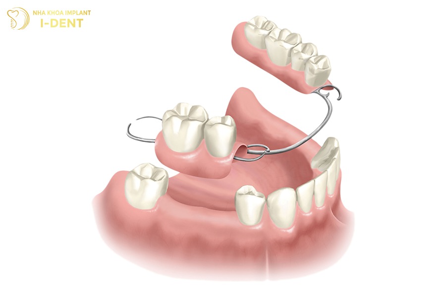 Trồng răng bằng cách sử dụng hàm tháo lắp trồng răng phục hình
