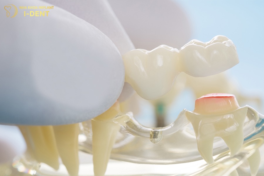 Trồng răng bằng phương pháp cầu răng sứ trồng răng là gì