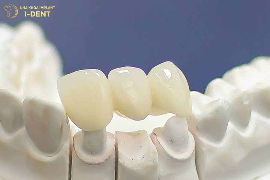 Trồng răng hàm bị sâu bằng phương pháp cầu răng sứ trồng răng bị sâu