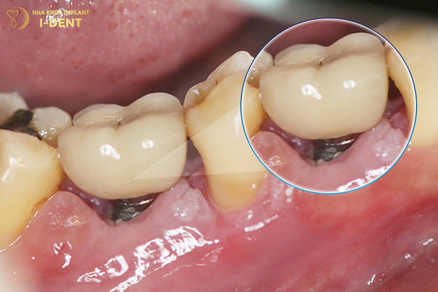 Viêm quanh trụ Implant Viêm quanh trụ Implant