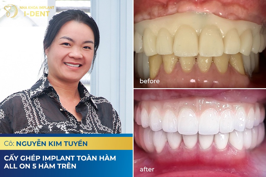hình ảnh khách hàng trồng răng phục hình tại nha khoa I-Dent hình ảnh khách hàng trồng răng phục hình tại nha khoa I-Dent
