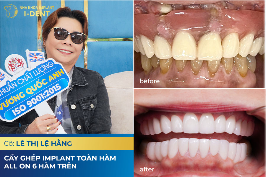 Trồng răng phục hình tại nha khoa I-Dent Trồng răng phục hình tại nha khoa I-Dent