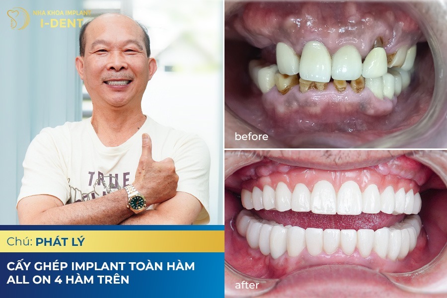 hình ảnh khách hàng trồng răng tại nha khoa I-Dent trồng răng là gì