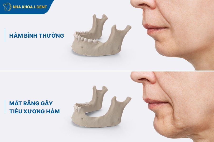 tiêu xương