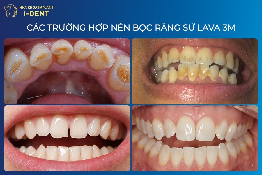 Các trường hợp nên bọc răng sứ Lava 3M răng sứ 3M Lava Plus