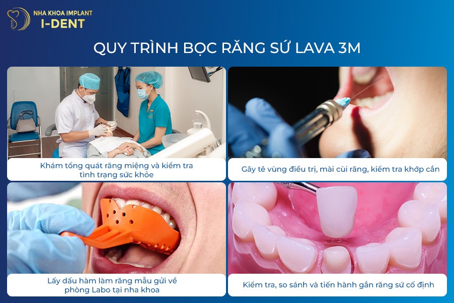Quy trình bọc răng sứ Lava Plus 3M răng sứ Lava Plus 3M