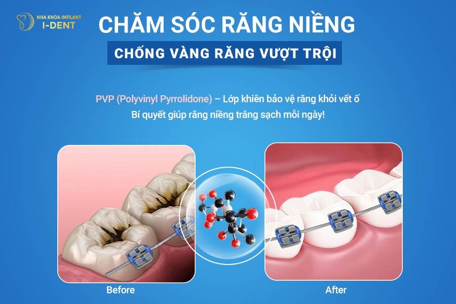 Nước súc miệng Waterine Ortho có chứa thành phần PVP Nước súc miệng Waterine Ortho có chứa thành phần PVP