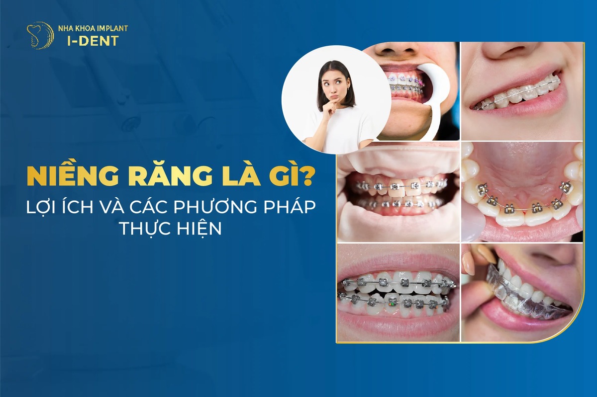 Niềng răng: Giá, Các Phương Pháp, Địa chỉ uy tín và Lợi ích