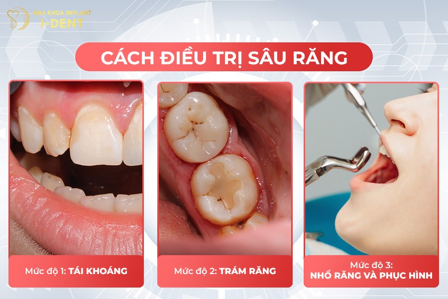 sâu răng nặng
