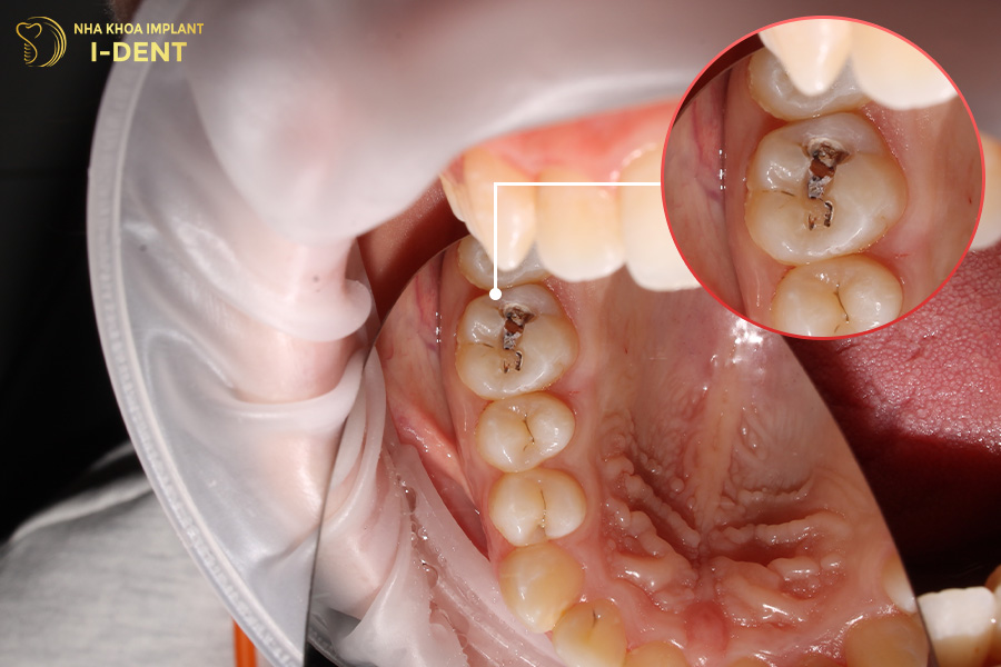 sâu răng nặng