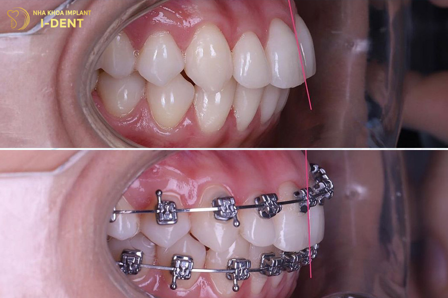 bắt vít niềng răng hô