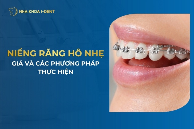 Răng Hô Nhẹ Là Gì? Có Nên Niềng Răng Hô Nhẹ?