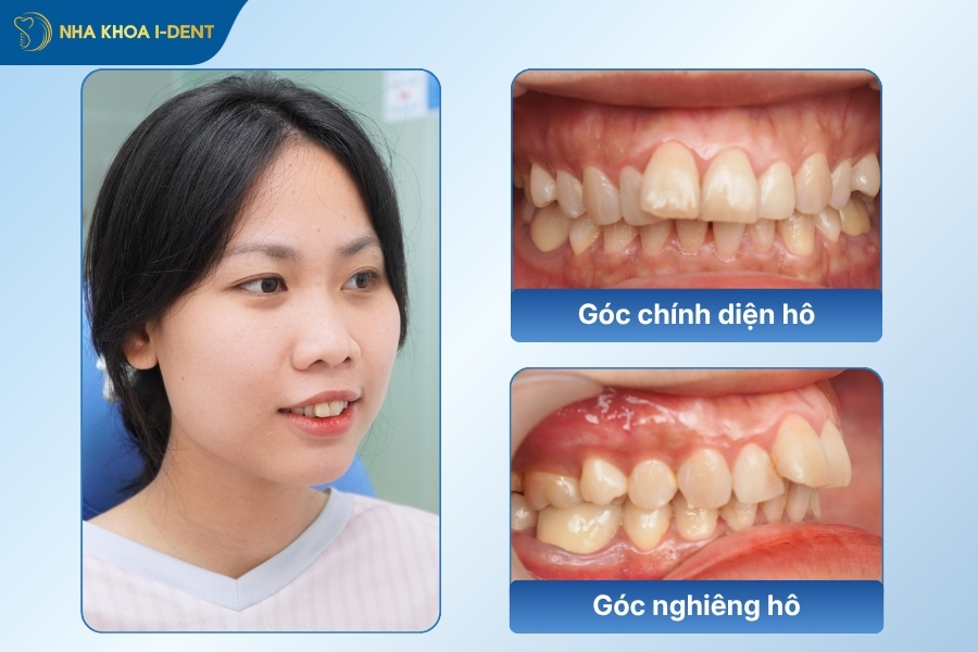 niềng răng hô