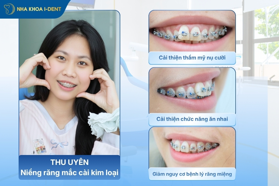 niềng răng hô
