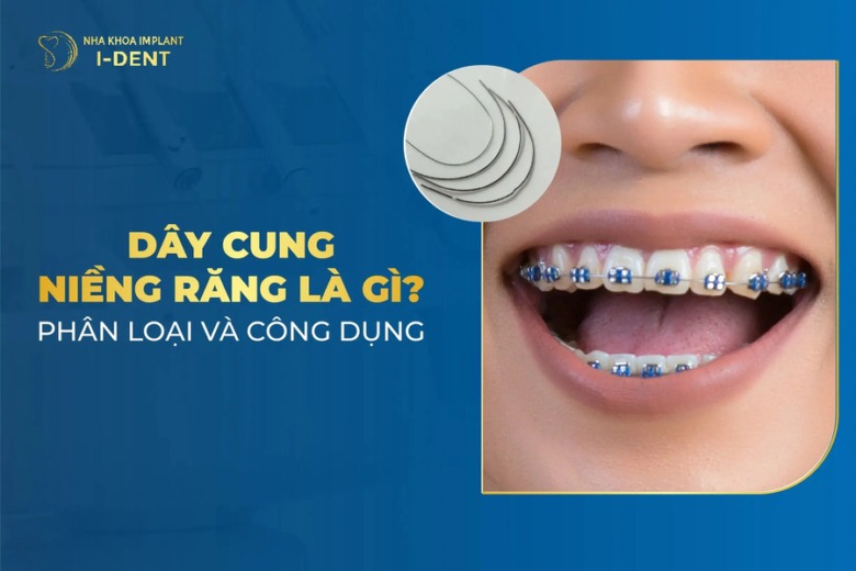 Dây cung niềng răng: Phân loại, tác dụng và kích thước