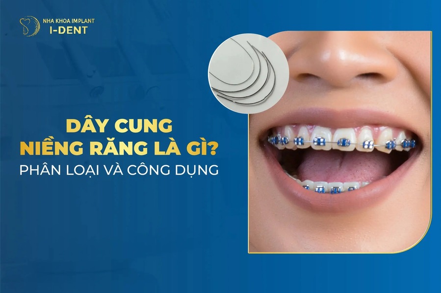 Dây cung niềng răng: Phân loại, tác dụng và kích thước