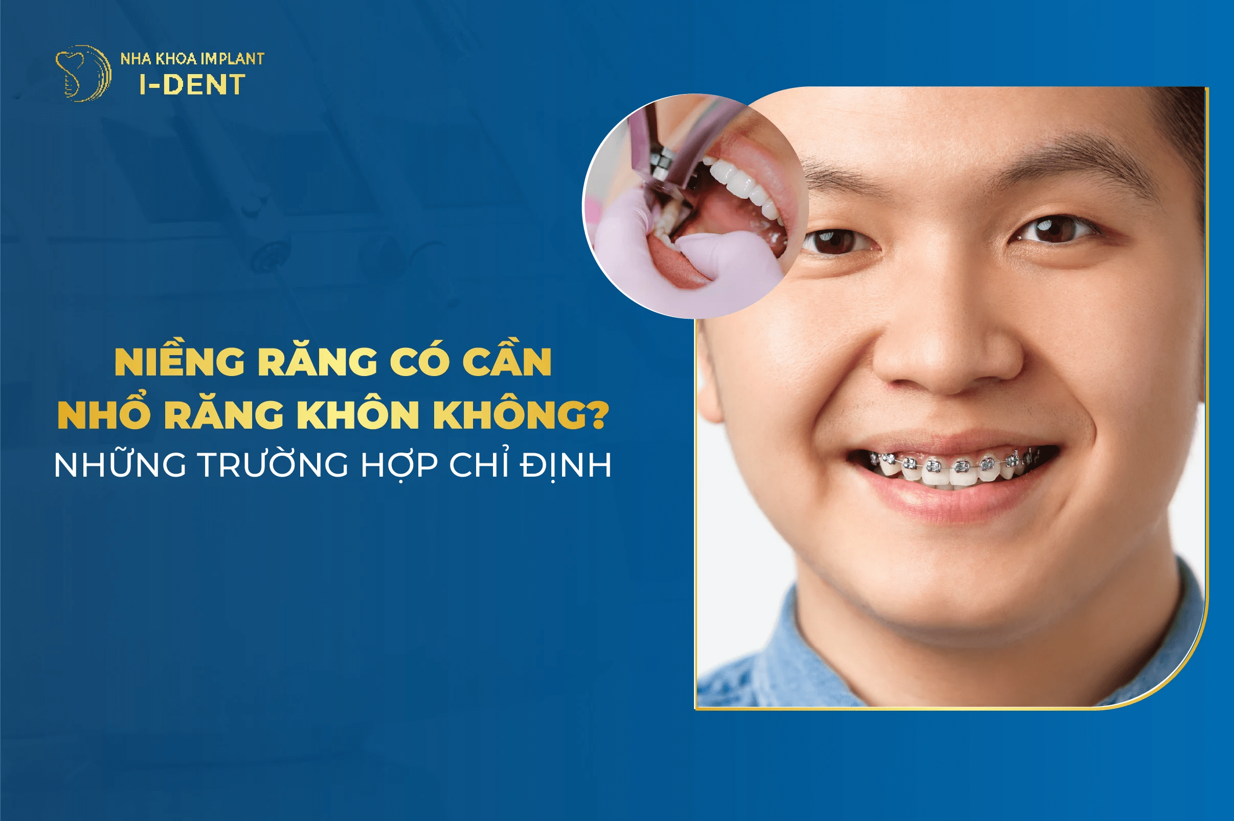 Niềng Răng Có Cần Phải Nhổ Răng Khôn Không?