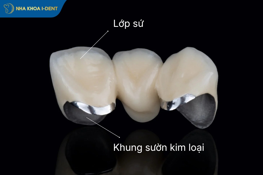 răng sứ kim loại