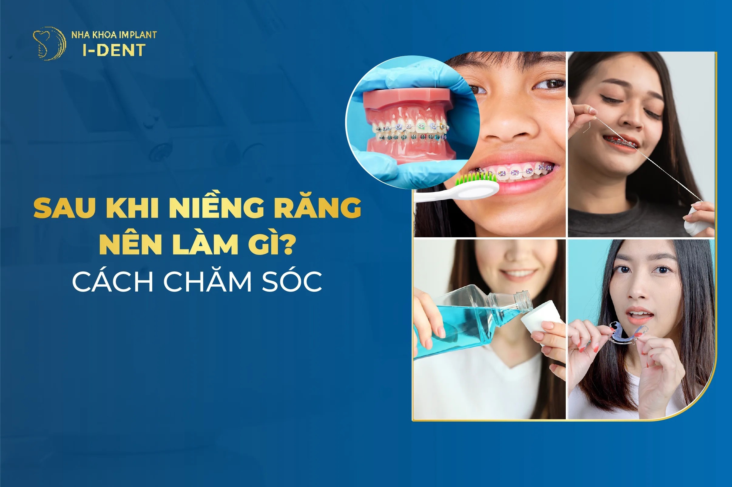 Hướng Dẫn Chăm Sóc Sau Khi Niềng Răng