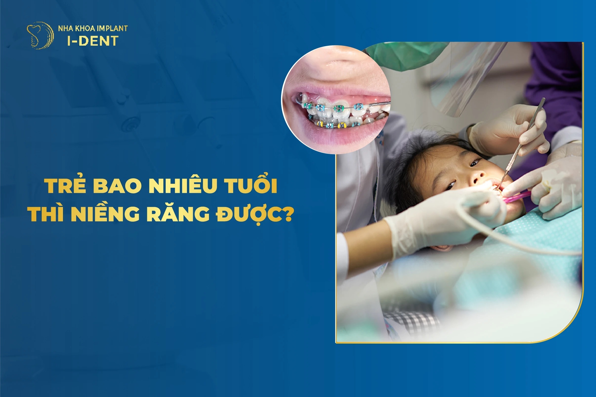 Trẻ Bao Nhiêu Tuổi Thì Niềng Răng Được?