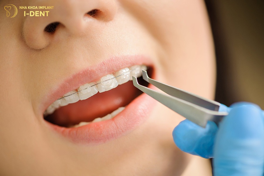 18 tuổi niềng răng mắc cài sứ