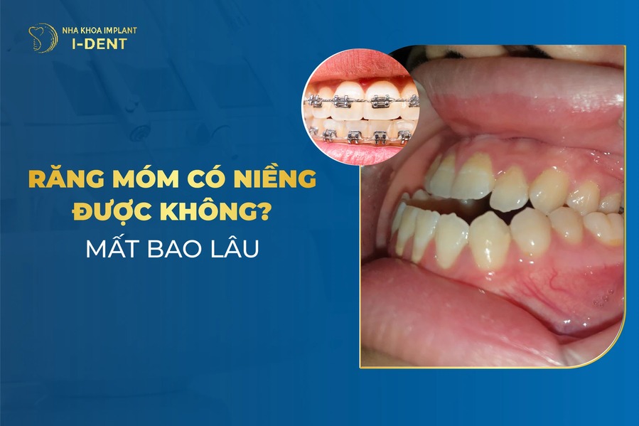 Bị móm có niềng răng được không? Có nên không?