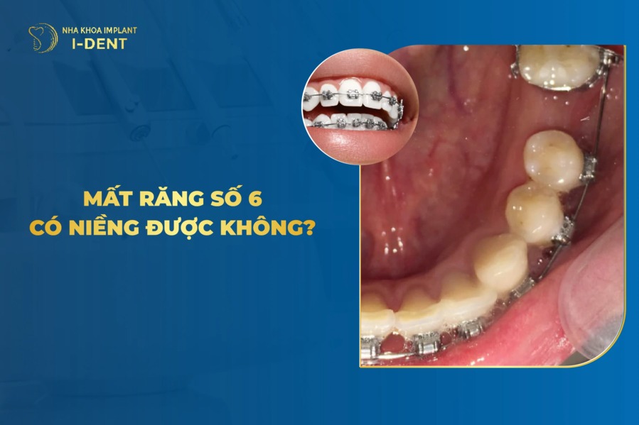 Bị mất răng số 6 có niềng răng được không?