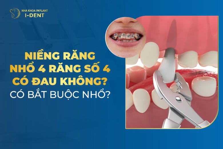 Có nên nhổ răng số 4 để niềng không? Tại sao phải nhổ?