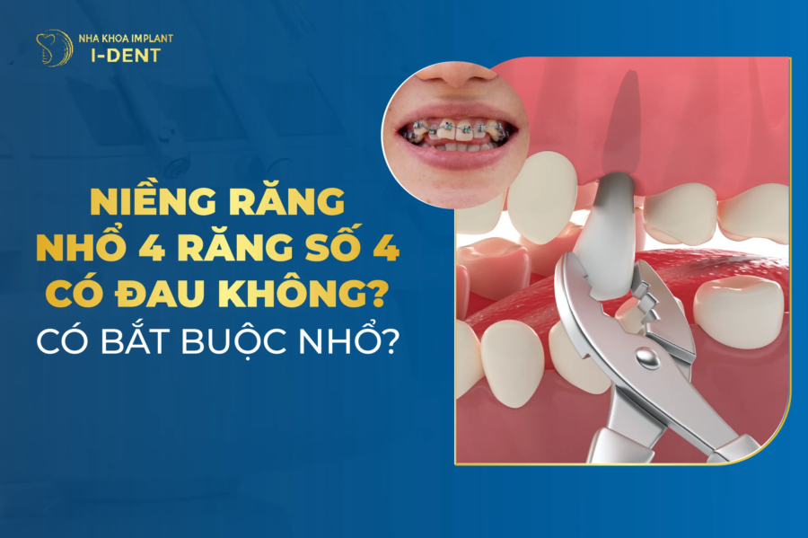 Có nên nhổ răng số 4 để niềng không? Tại sao phải nhổ?