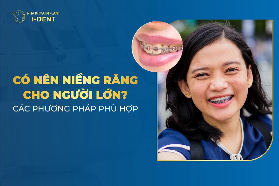 Niềng răng ở người lớn có nên không? Giá bao nhiêu?