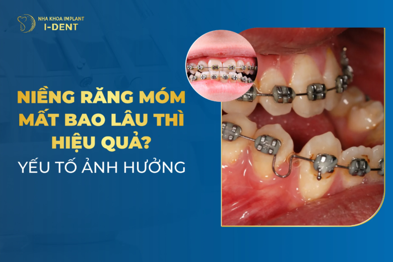 Niềng Răng Móm Mất Bao Lâu? Yếu Tố Ảnh Hưởng