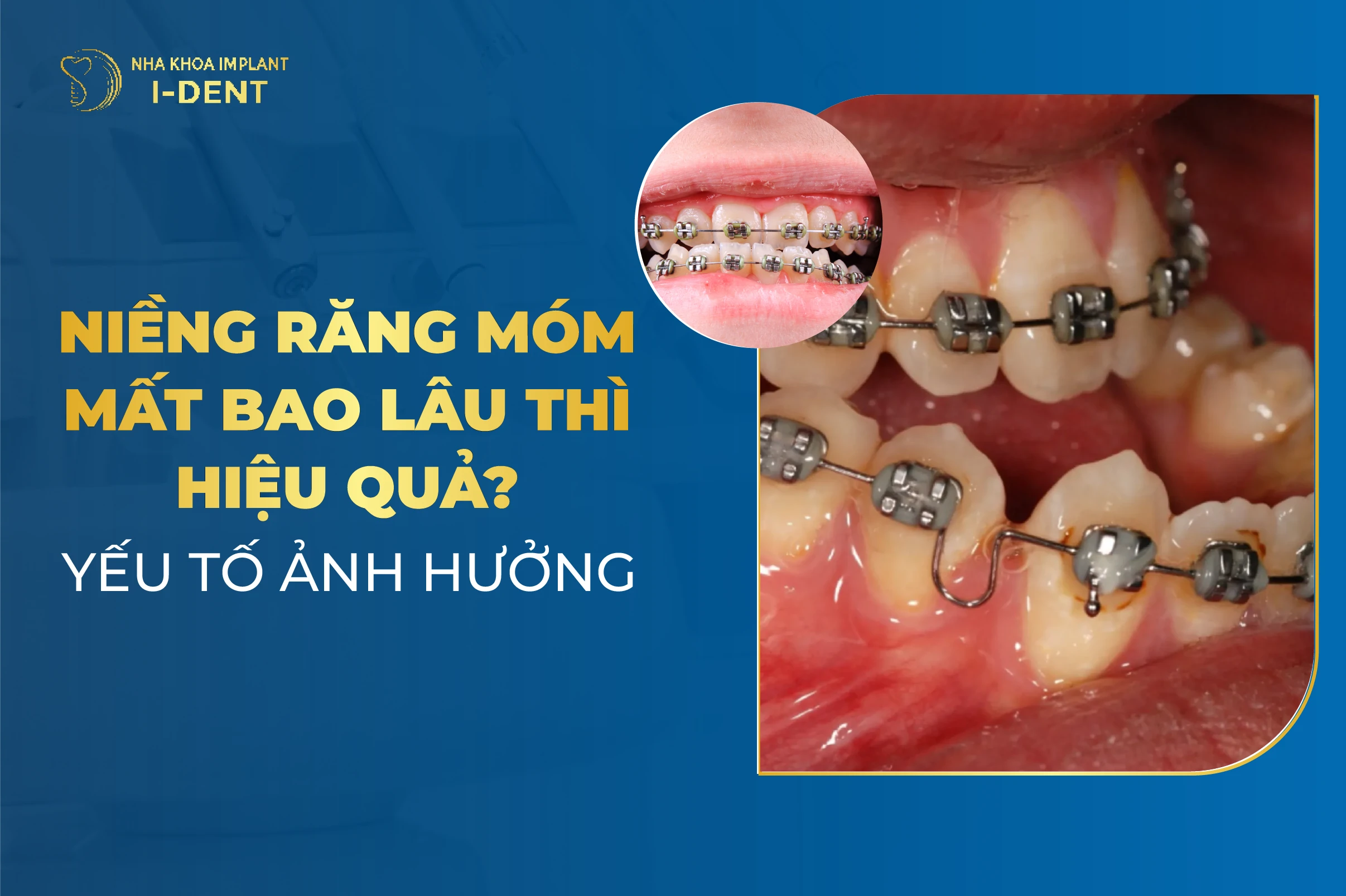 Niềng Răng Móm Mất Bao Lâu? Yếu Tố Ảnh Hưởng