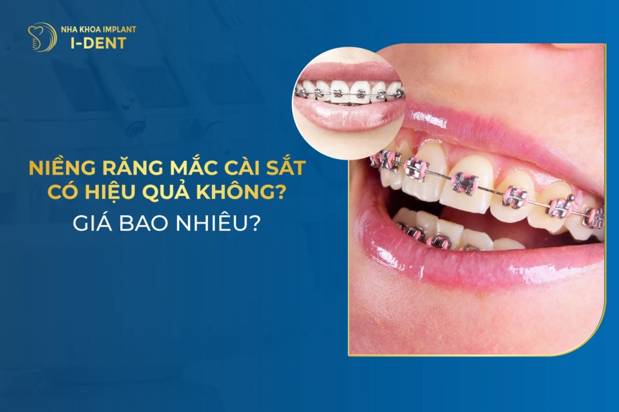 Niềng Răng Mắc Cài Sắt: Có Hiệu Quả Không? Giá Bao Nhiêu?