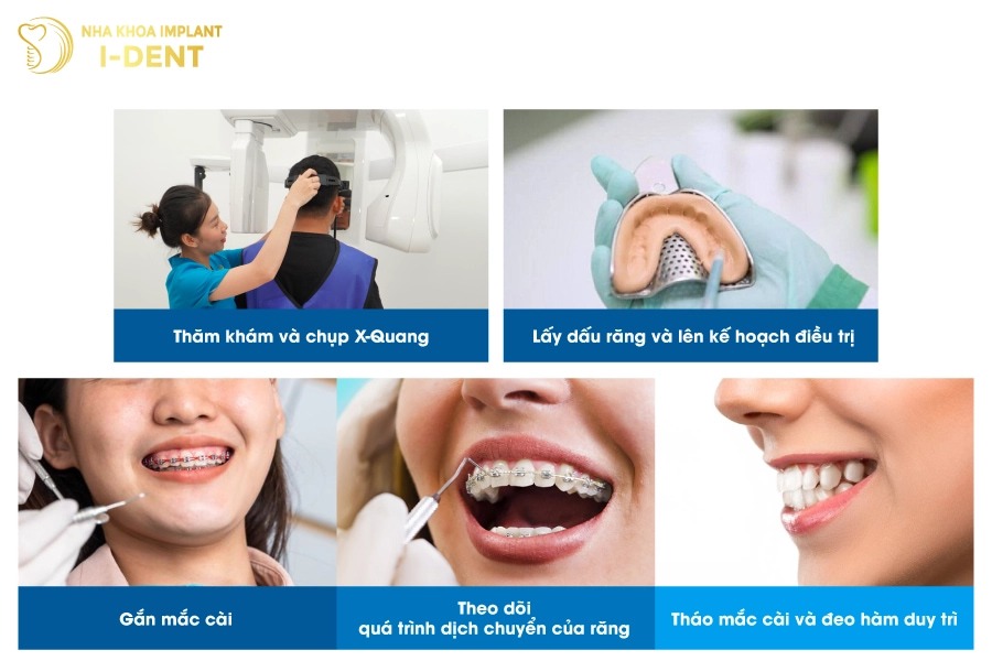 niềng mắc cài sứ