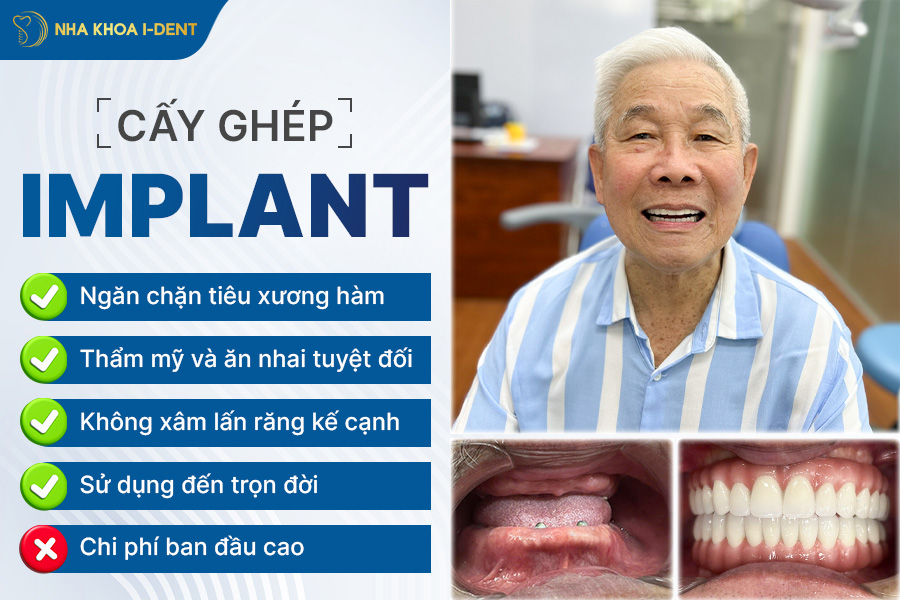 trồng răng mất chân răng được không