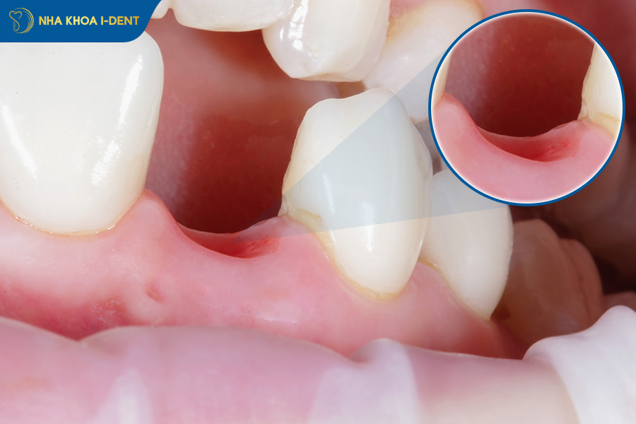 Trồng răng sứ khi bị mất răng