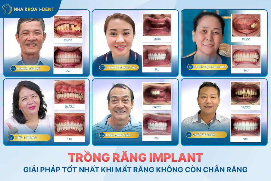 trồng răng sứ không có chân răng được không