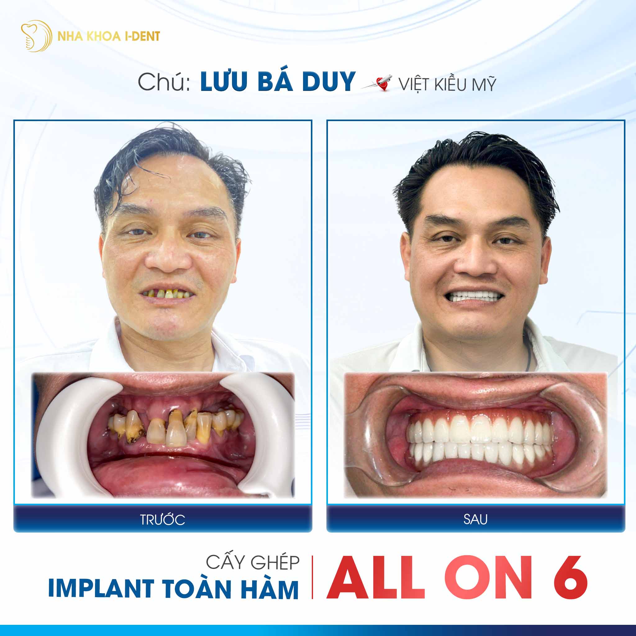 khách hàng cấy implant