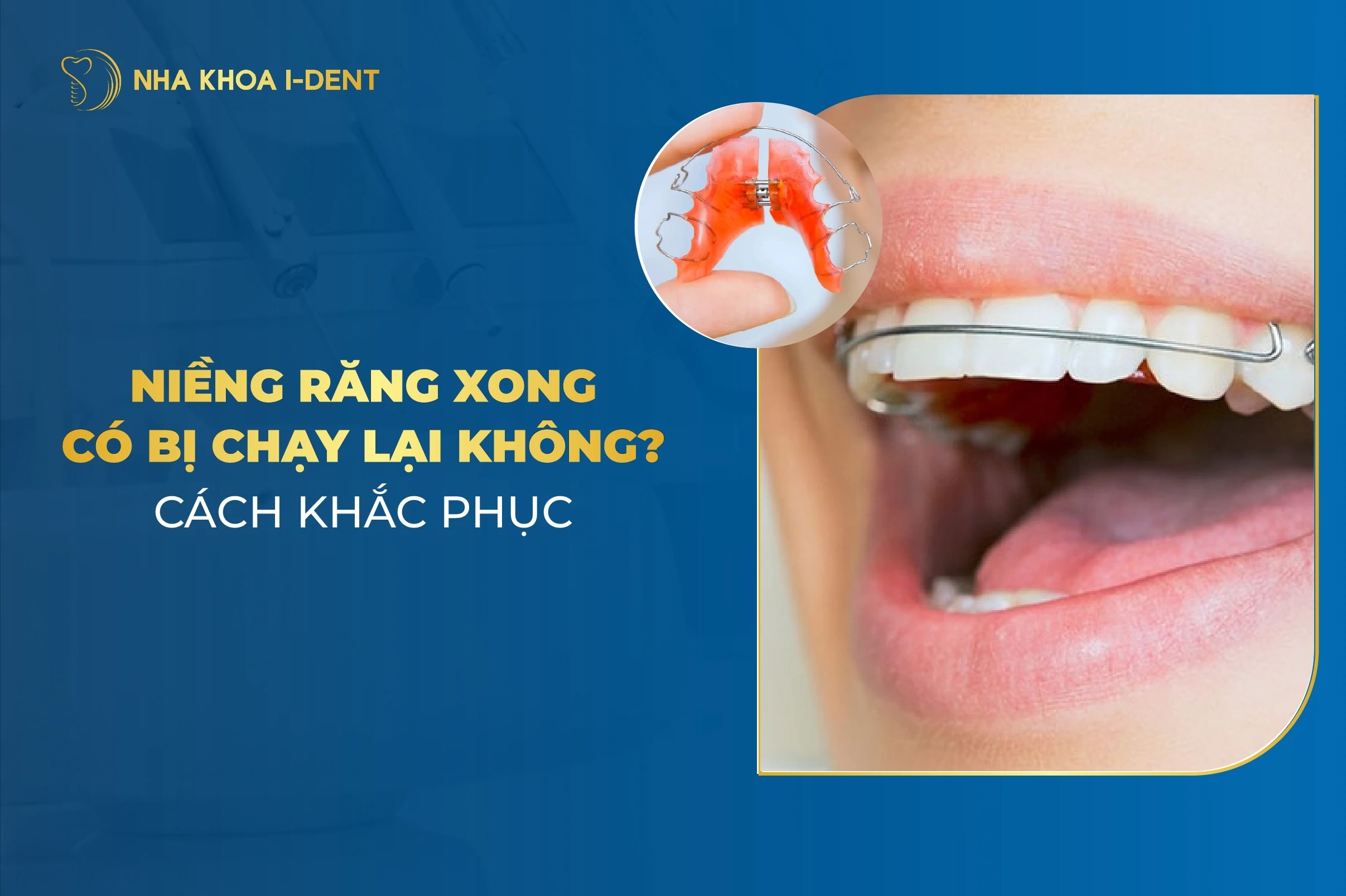 Niềng răng xong có bị chạy lại không? Cách khắc phục