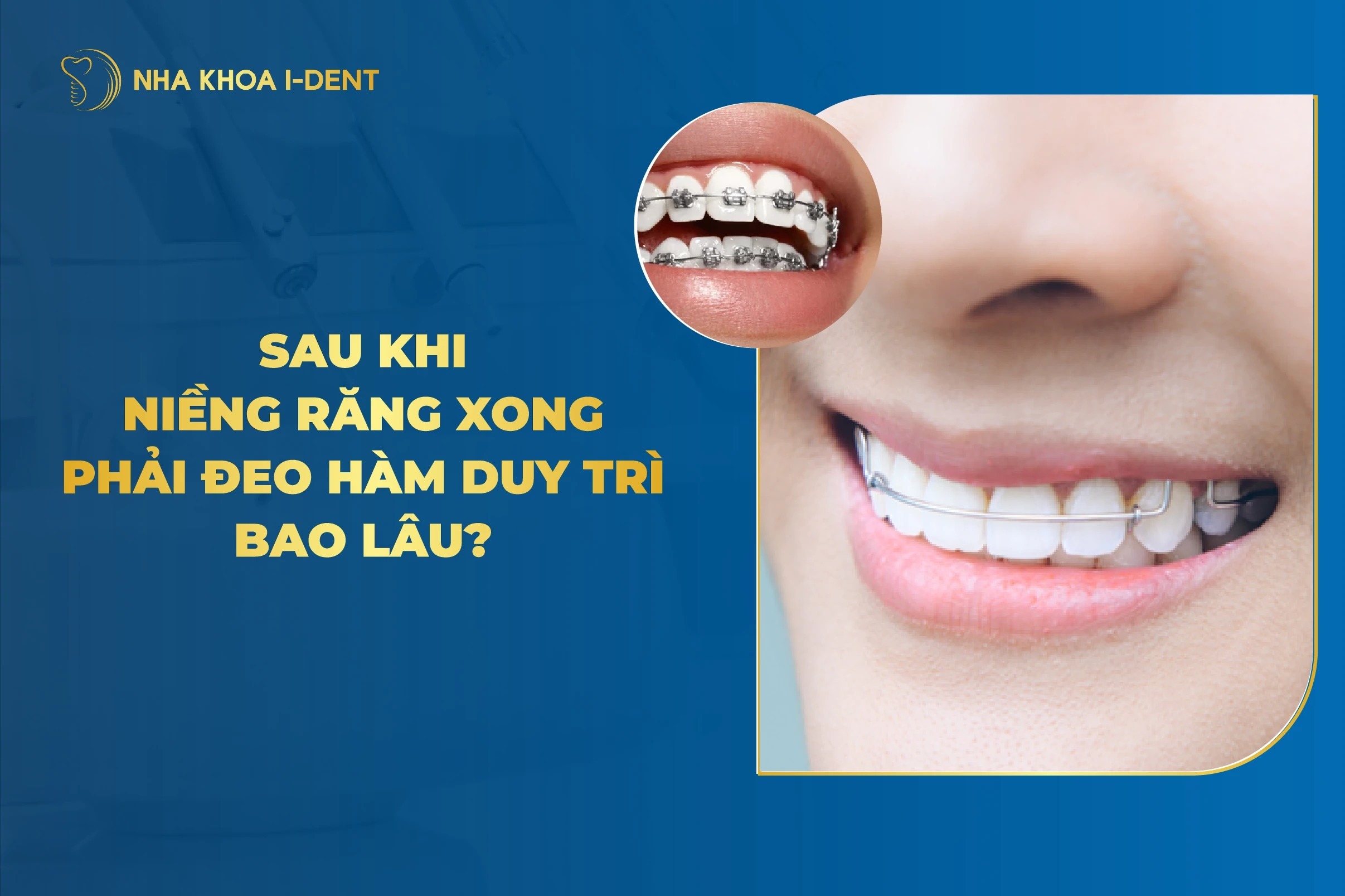 Sau Khi Niềng Răng Xong Phải Đeo Hàm Duy Trì Bao Lâu?