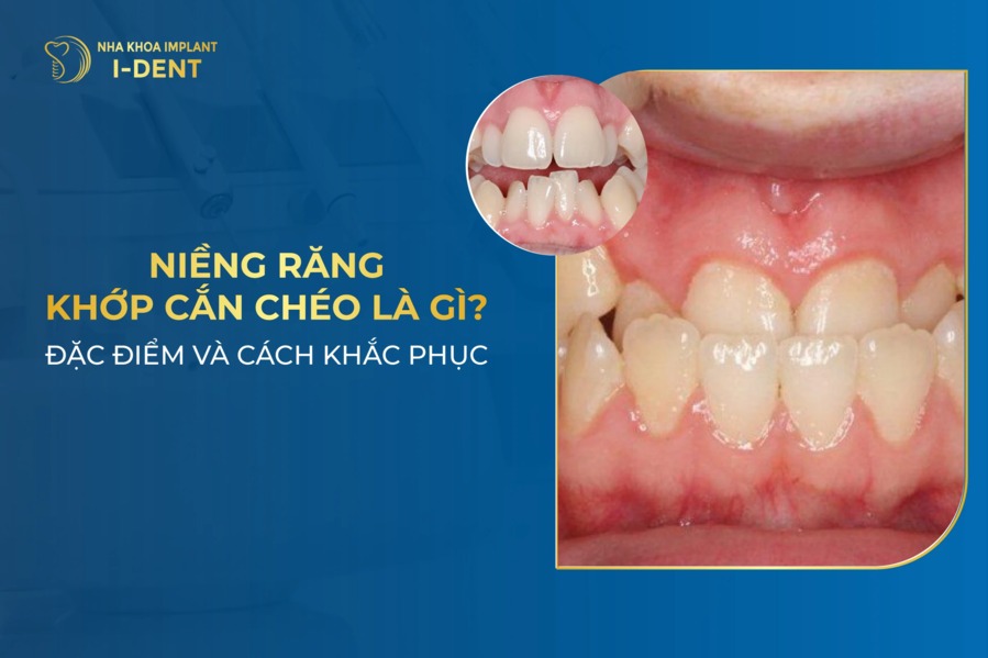 Khớp cắn chéo là gì? Đặc điểm và cách điều trị cắn chéo