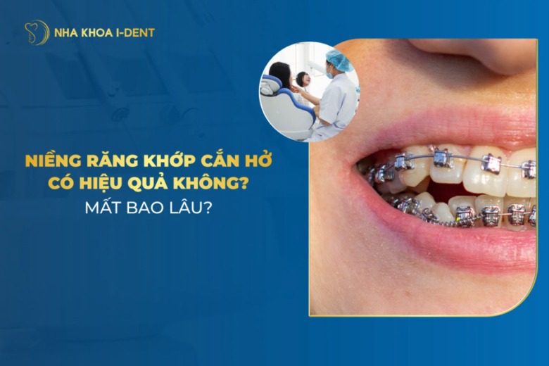 Niềng răng khớp cắn hở mất bao lâu? Có hiệu quả không?